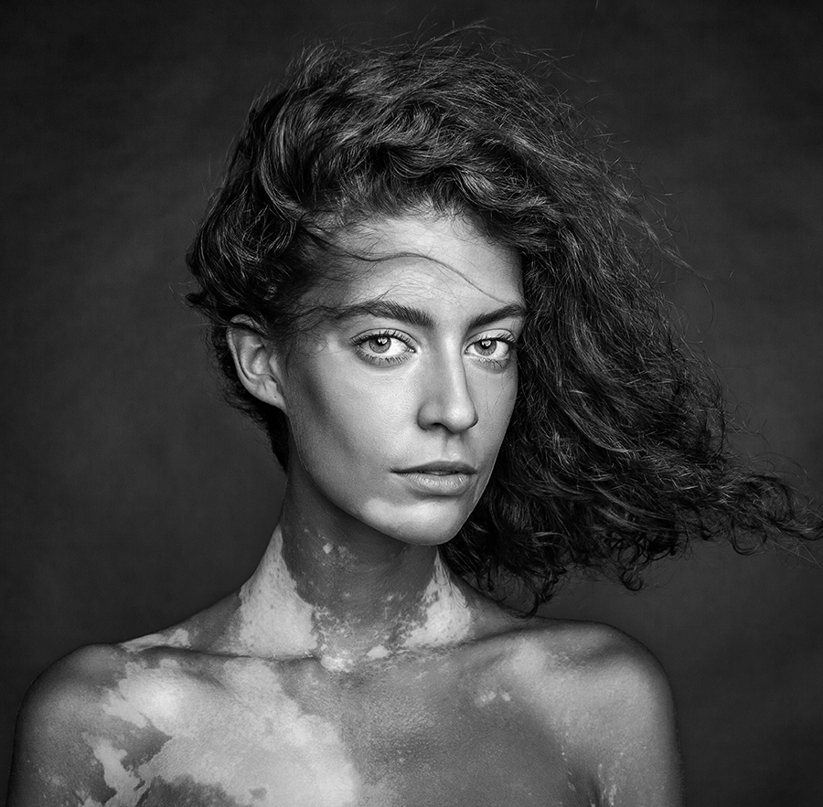 Girl with vitiligo by Mikhail Shestakov (Russian Federation) – 1st Place Winner – People Discovery of the Year 2016